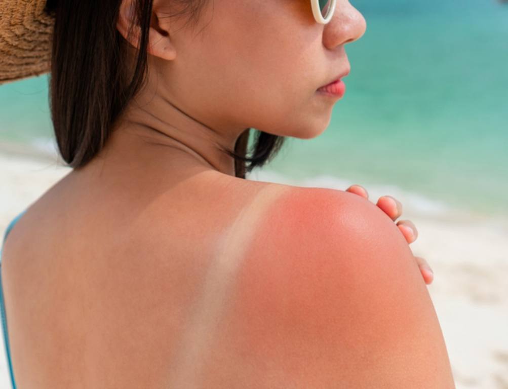 Sunburned skin on shoulder of a woman because of not using cream with sunscreen protection. Red skin sun burn after Sunbathing at the beach. Summer and holiday concept