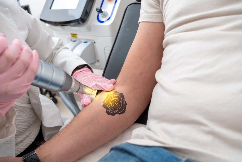 Close-up of a man's forearm with a rose tattoo and a tattoo removal device held by a technician.